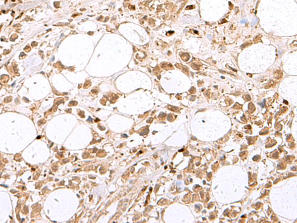 RBFOX2 / RBM9 Antibody - Immunohistochemistry of paraffin-embedded Human breast cancer tissue  using RBFOX2 Polyclonal Antibody at dilution of 1:80(×200)