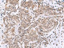 RBFOX2 / RBM9 Antibody - Immunohistochemistry of paraffin-embedded Human lung cancer tissue  using RBFOX2 Polyclonal Antibody at dilution of 1:50(×200)