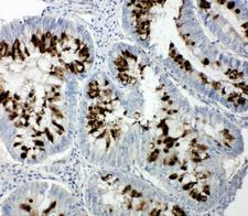 RBL1 / p107 Antibody - RBL1 / p107 antibody. IHC(P): Human Intestinal Cancer Tissue.