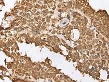 RBL2 / RB2 p130 Antibody - Immunohistochemistry of paraffin-embedded Human ovarian cancer tissue  using RBL2 Polyclonal Antibody at dilution of 1:45(×200)