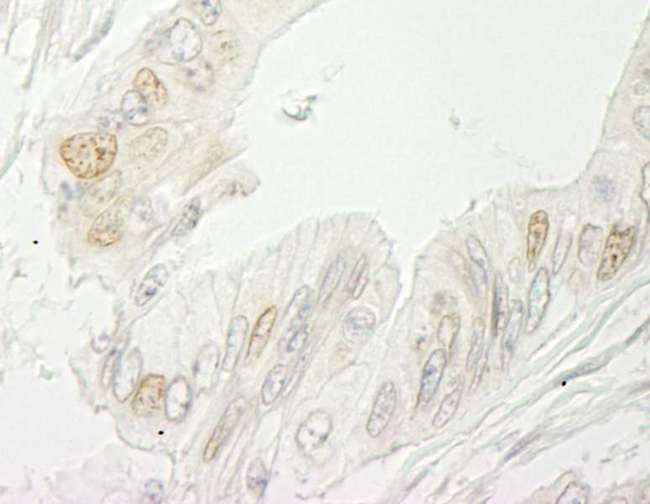 RBM10 Antibody - Detection of Human RBM10 by Immunohistochemistry. Sample: FFPE section of human colon carcinoma. Antibody: Affinity purified rabbit anti-RBM10 used at a dilution of 1:200.
