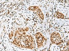 RBM10 Antibody - Immunohistochemistry of paraffin-embedded Human esophagus cancer tissue  using RBM10 Polyclonal Antibody at dilution of 1:50(×200)