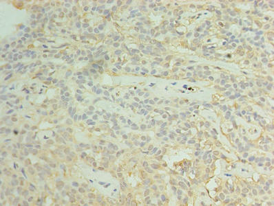 RBM11 Antibody - Immunohistochemistry of paraffin-embedded human breast cancer using RBM11 Antibody at dilution of 1:100