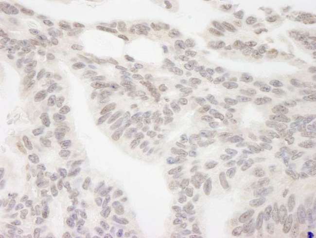 RBM12 Antibody - Detection of Human RBM12 by Immunohistochemistry. Sample: FFPE section of human ovarian carcinoma. Antibody: Affinity purified rabbit anti-RBM12 used at a dilution of 1:250.