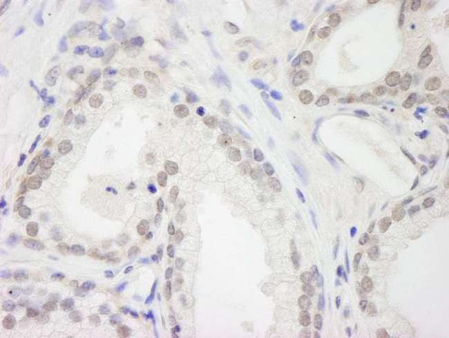 RBM12 Antibody - Detection of Human RBM12 by Immunohistochemistry. Sample: FFPE section of human prostate carcinoma. Antibody: Affinity purified rabbit anti-RBM12 used at a dilution of 1:250.