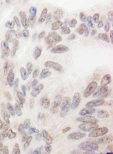 RBM12 Antibody - Detection of Human RBM12 by Immunohistochemistry. Sample: FFPE section of human ovarian carcinoma. Antibody: Affinity purified rabbit anti-RBM12 used at a dilution of 1:200 (1 ug/ml). Detection: DAB.
