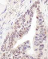 RBM12 Antibody - Detection of Human RBM12 by Immunohistochemistry. Sample: FFPE section of human ovarian carcinoma. Antibody: Affinity purified rabbit anti-RBM12 used at a dilution of 1:200 (1 ug/ml). Detection: DAB.