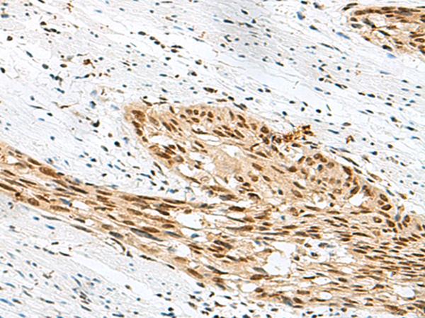 RBM12 Antibody - Immunohistochemistry of paraffin-embedded Human esophagus cancer tissue  using RBM12 Polyclonal Antibody at dilution of 1:50(×200)