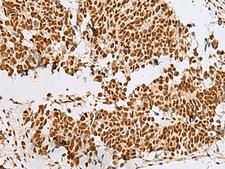 RBM12 Antibody - Immunohistochemistry of paraffin-embedded Human lung cancer tissue  using RBM12 Polyclonal Antibody at dilution of 1:50(×200)