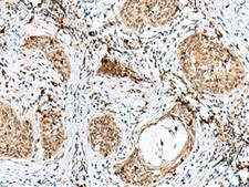 RBM15 Antibody - Immunohistochemistry of paraffin-embedded Human esophagus cancer tissue  using RBM15 Polyclonal Antibody at dilution of 1:50(×200)