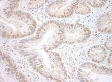 RBM17 Antibody - Detection of Human SPF45 by Immunohistochemistry. Sample: FFPE section of human colon carcinoma. Antibody: Affinity purified rabbit anti-SPF45 used at a dilution of 1:250.
