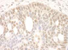 RBM17 Antibody - Detection of Human SPF45 by Immunohistochemistry. Sample: FFPE section of human ovarian carcinoma. Antibody: Affinity purified rabbit anti-SPF45 used at a dilution of 1:1000 (1 ug/ml). Detection: DAB.