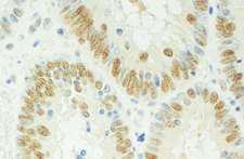 RBM17 Antibody - Detection of Human SPF45 by Immunohistochemistry. Sample: FFPE section of human colon carcinoma. Antibody: Affinity purified rabbit anti-SPF45 used at a dilution of 1:200 (1 ug/ml). Detection: DAB.