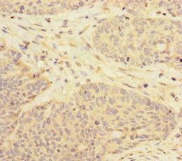RBM17 Antibody - Immunohistochemistry of paraffin-embedded human ovarian cancer at dilution of 1:100
