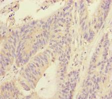 RBM17 Antibody - Immunohistochemistry of paraffin-embedded human colon cancer at dilution of 1:100
