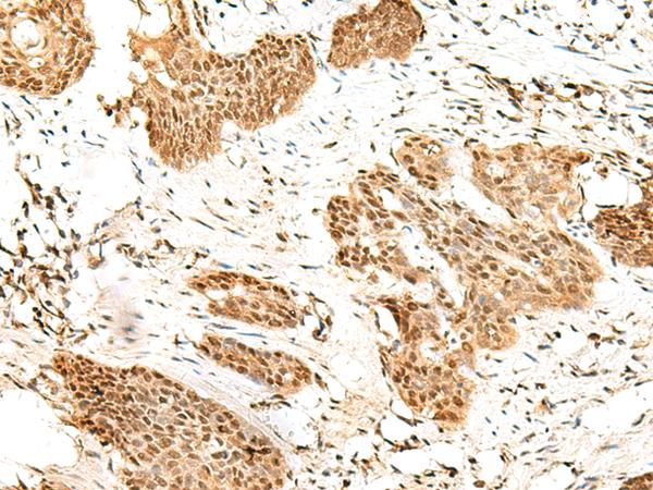 RBM19 Antibody - Immunohistochemistry of paraffin-embedded Human esophagus cancer tissue  using RBM19 Polyclonal Antibody at dilution of 1:45(×200)