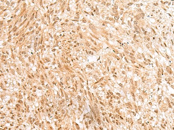RBM19 Antibody - Immunohistochemistry of paraffin-embedded Human liver cancer tissue  using RBM19 Polyclonal Antibody at dilution of 1:45(×200)