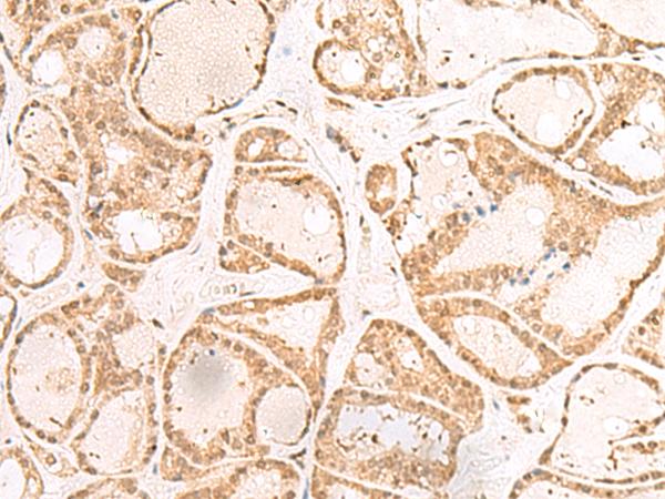 RBM19 Antibody - Immunohistochemistry of paraffin-embedded Human thyroid cancer tissue  using RBM19 Polyclonal Antibody at dilution of 1:30(×200)