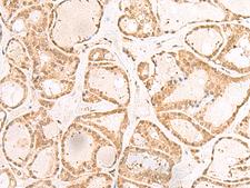 RBM19 Antibody - Immunohistochemistry of paraffin-embedded Human thyroid cancer tissue  using RBM19 Polyclonal Antibody at dilution of 1:30(×200)