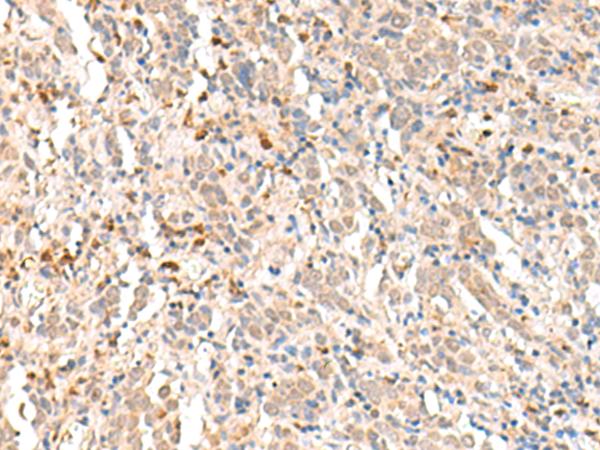 RBM19 Antibody - Immunohistochemistry of paraffin-embedded Human cervical cancer tissue  using RBM19 Polyclonal Antibody at dilution of 1:30(×200)