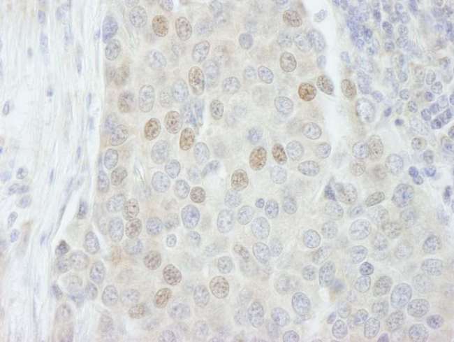RBM27 Antibody - Detection of Human RBM27 by Immunohistochemistry. Sample: FFPE section of human breast carcinoma. Antibody: Affinity purified rabbit anti-RBM27 used at a dilution of 1:250.