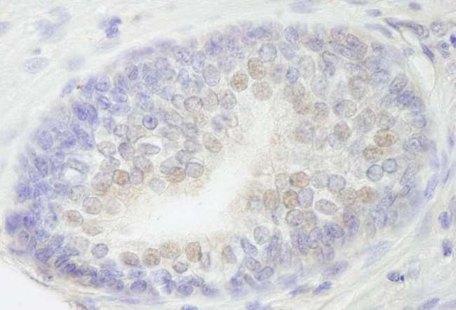 RBM27 Antibody - Detection of Human RBM27 by Immunohistochemistry. Sample: FFPE section of human prostate carcinoma. Antibody: Affinity purified rabbit anti-RBM27 used at a dilution of 1:250.
