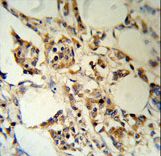 RBM3 Antibody - RBM3 Antibody (RB18777) IHC of formalin-fixed and paraffin-embedded human breast carcinoma followed by peroxidase-conjugated secondary antibody and DAB staining.