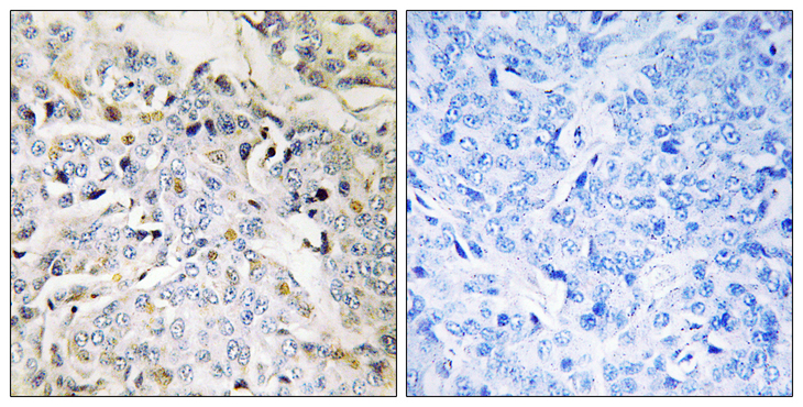 RBM34 Antibody - Immunohistochemistry analysis of paraffin-embedded human breast carcinoma tissue, using RBM34 Antibody. The picture on the right is blocked with the synthesized peptide.