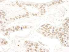 RBM34 Antibody - Detection of Human RBM34 by Immunohistochemistry. Sample: FFPE section of human breast carcinoma. Antibody: Affinity purified rabbit anti-RBM34 used at a dilution of 1:250.