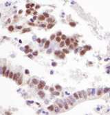 RBM39 Antibody - Detection of Human Caper by Immunohistochemistry. Sample: FFPE section of human stomach carcinoma. Antibody: Affinity purified rabbit anti-Caper used at a dilution of 1:5000 (0.2 ug/ml).