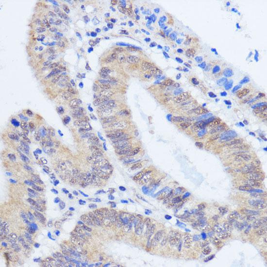 RBM39 Antibody - Immunohistochemistry of paraffin-embedded Human colon carcinoma using RBM39 Polyclonal Antibody at dilution of 1:100 (40x lens).