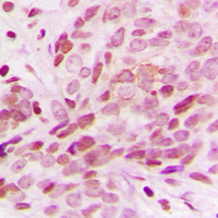 RBM5 / G15 Antibody - Immunohistochemical analysis of G15 staining in human breast cancer formalin fixed paraffin embedded tissue section. The section was pre-treated using heat mediated antigen retrieval with sodium citrate buffer (pH 6.0). The section was then incubated with the antibody at room temperature and detected using an HRP-conjugated compact polymer system. DAB was used as the chromogen. The section was then counterstained with hematoxylin and mounted with DPX.