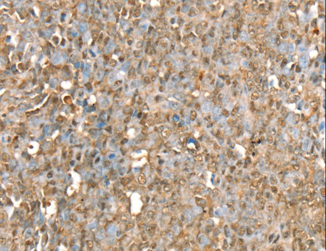 RBM5 / G15 Antibody - Immunohistochemistry of paraffin-embedded Human ovarian cancer using RBM5 Polyclonal Antibody at dilution of 1:30.