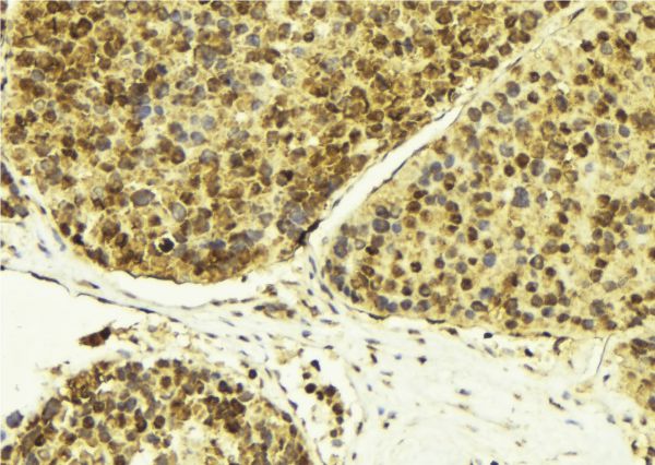 RBM5 / G15 Antibody - 1:100 staining human breast carcinoma tissue by IHC-P. The sample was formaldehyde fixed and a heat mediated antigen retrieval step in citrate buffer was performed. The sample was then blocked and incubated with the antibody for 1.5 hours at 22°C. An HRP conjugated goat anti-rabbit antibody was used as the secondary.