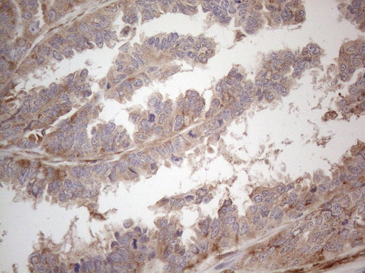 RBMS1 Antibody - Immunohistochemical staining of paraffin-embedded Adenocarcinoma of Human ovary tissue using anti-RBMS1 mouse monoclonal antibody. (Heat-induced epitope retrieval by 1mM EDTA in 10mM Tris buffer. (pH8.5) at 120°C for 3 min. (1:150)