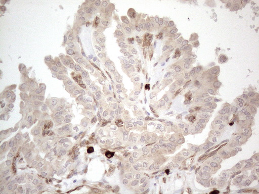 RBMS1 Antibody - Immunohistochemical staining of paraffin-embedded Carcinoma of Human thyroid tissue using anti-RBMS1 mouse monoclonal antibody. (Heat-induced epitope retrieval by 1mM EDTA in 10mM Tris buffer. (pH8.5) at 120°C for 3 min. (1:150)