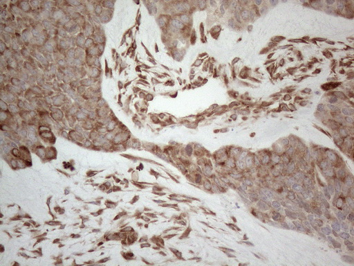 RBMS1 Antibody - Immunohistochemical staining of paraffin-embedded Adenocarcinoma of Human endometrium tissue using anti-RBMS1 mouse monoclonal antibody. (Heat-induced epitope retrieval by 1mM EDTA in 10mM Tris buffer. (pH8.5) at 120°C for 3 min. (1:150)