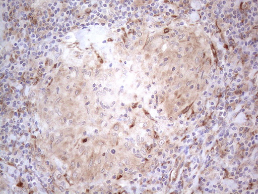 RBMS1 Antibody - Immunohistochemical staining of paraffin-embedded Human lymph node tissue within the normal limits using anti-RBMS1 mouse monoclonal antibody. (Heat-induced epitope retrieval by 1mM EDTA in 10mM Tris buffer. (pH8.5) at 120°C for 3 min. (1:150)