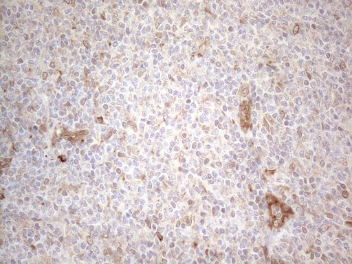 RBMS1 Antibody - Immunohistochemical staining of paraffin-embedded Human lymphoma tissue using anti-RBMS1 mouse monoclonal antibody. (Heat-induced epitope retrieval by 1mM EDTA in 10mM Tris buffer. (pH8.5) at 120°C for 3 min. (1:150)