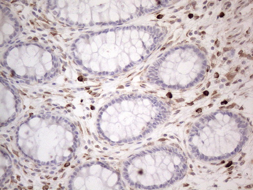 RBMS1 Antibody - Immunohistochemical staining of paraffin-embedded Human colon tissue within the normal limits using anti-RBMS1 mouse monoclonal antibody. (Heat-induced epitope retrieval by 1mM EDTA in 10mM Tris buffer. (pH8.5) at 120°C for 3 min. (1:150)