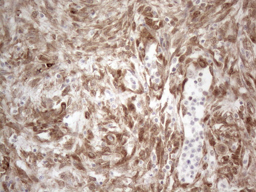 RBMS1 Antibody - Immunohistochemical staining of paraffin-embedded Adenocarcinoma of Human colon tissue using anti-RBMS1 mouse monoclonal antibody. (Heat-induced epitope retrieval by 1mM EDTA in 10mM Tris buffer. (pH8.5) at 120°C for 3 min. (1:150)