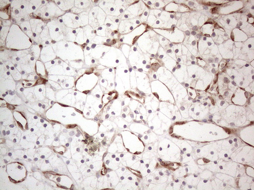 RBMS1 Antibody - Immunohistochemical staining of paraffin-embedded Carcinoma of Human kidney tissue using anti-RBMS1 mouse monoclonal antibody. (Heat-induced epitope retrieval by 1mM EDTA in 10mM Tris buffer. (pH8.5) at 120°C for 3 min. (1:150)
