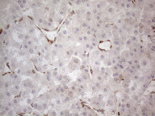 RBMS1 Antibody - Immunohistochemical staining of paraffin-embedded Carcinoma of Human liver tissue using anti-RBMS1 mouse monoclonal antibody. (Heat-induced epitope retrieval by 1mM EDTA in 10mM Tris buffer. (pH8.5) at 120°C for 3 min. (1:150)