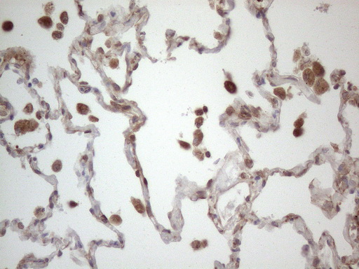 RBMS1 Antibody - Immunohistochemical staining of paraffin-embedded Human lung tissue within the normal limits using anti-RBMS1 mouse monoclonal antibody. (Heat-induced epitope retrieval by 1mM EDTA in 10mM Tris buffer. (pH8.5) at 120°C for 3 min. (1:150)