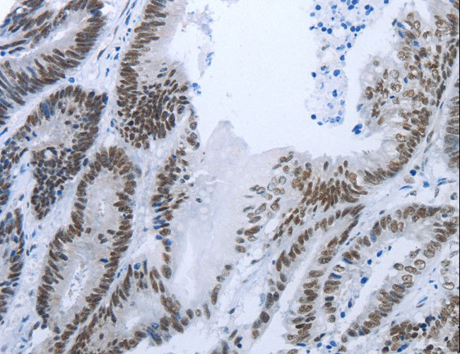 RBMS1 Antibody - Immunohistochemistry of paraffin-embedded Human ovarian cancer using RBMS1 Polyclonal Antibody at dilution of 1:30.