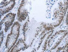 RBMS1 Antibody - Immunohistochemistry of paraffin-embedded Human ovarian cancer using RBMS1 Polyclonal Antibody at dilution of 1:30.