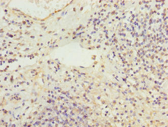 RBMS2 / SCR3 Antibody - Immunohistochemistry of paraffin-embedded human cervical cancer using RBMS2 Antibody at dilution of 1:100