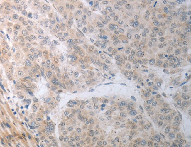 RBMS3 Antibody - Immunohistochemistry of paraffin-embedded Human liver cancer using RBMS3 Polyclonal Antibody at dilution of 1:70.