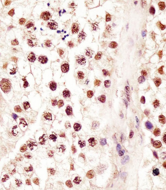 RBMX Antibody - Antibody staining RBMX in human testis tissue sections by Immunohistochemistry (IHC-P - paraformaldehyde-fixed, paraffin-embedded sections). Tissue was fixed with formaldehyde and blocked with 3% BSA for 0. 5 hour at room temperature; antigen retrieval was by heat mediation with a citrate buffer (pH 6). Samples were incubated with primary antibody (1:25) for 1 hours at 37°C. A undiluted biotinylated goat polyvalent antibody was used as the secondary antibody.
