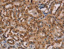 RBMX Antibody - Immunohistochemistry of paraffin-embedded Human thyroid cancer using RBMX Polyclonal Antibody at dilution of 1:45.
